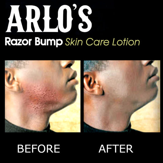Arlo's Razor Bump Skin Care Lotion - 6 oz